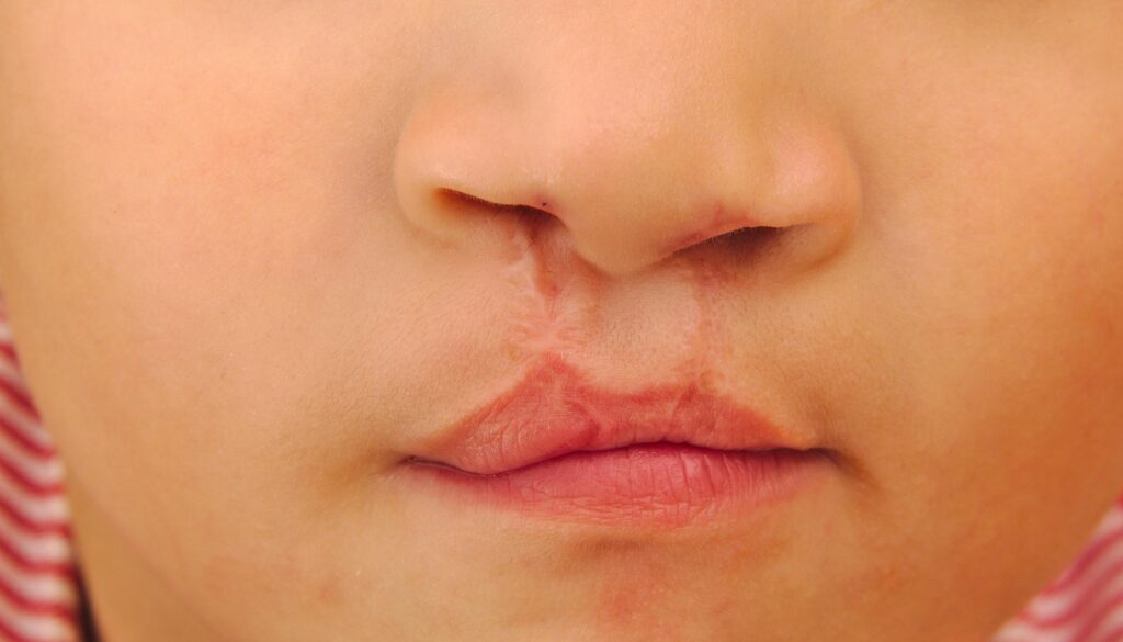 CleftlipandPalate_share