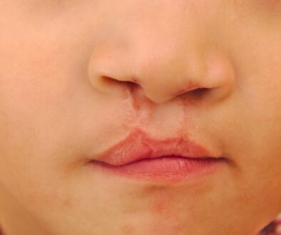 CleftlipandPalate_share