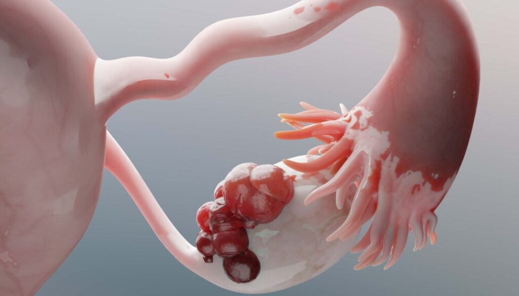 cancer-ovario