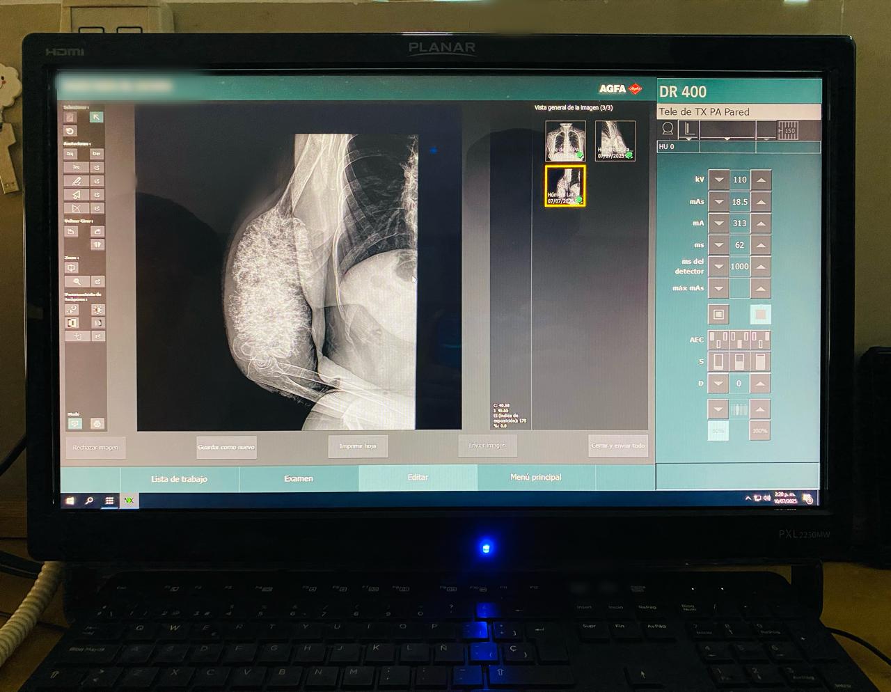 Recomienda IMSS Morelos identificar bultos en tejidos blandos ante presencia de sarcoma
